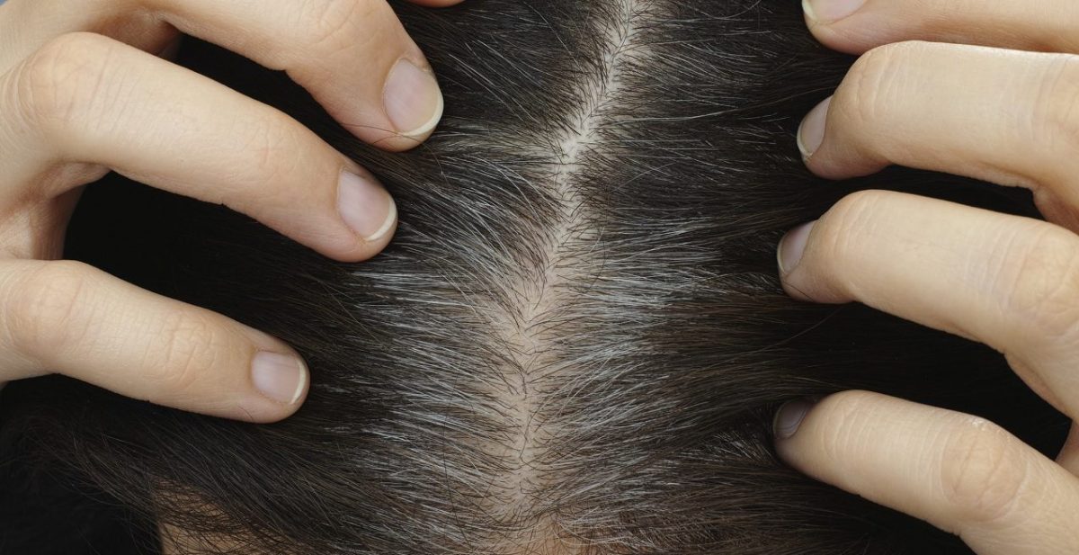 के तपाईंको पनि समयअघि नै कपाल फूल्न थाल्यो ? कारण जान्नुहोस्