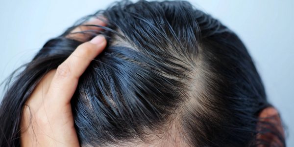स्काल्पमा हुने चिपचिप कम गर्ने उपाय