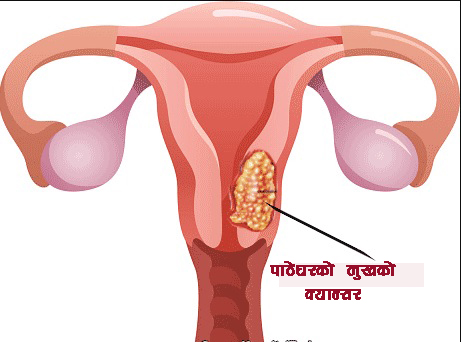 पाठेघरको मुखको क्यान्सरविरुद्ध खोप ल्याइयो