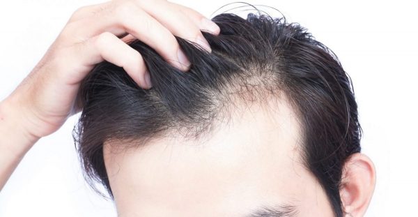 वर्षातको बेला किन झर्छ कपाल ? जानौं सही कारण