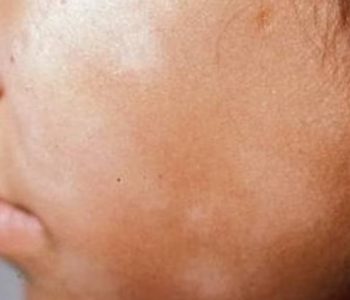 किन देखिन्छ अनुहारमा सेतो दाग ?