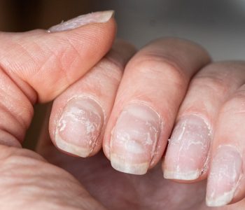 जाडोमा नङ धेरै किन टुक्रिन्छ ? स्याहार गर्ने तरिका