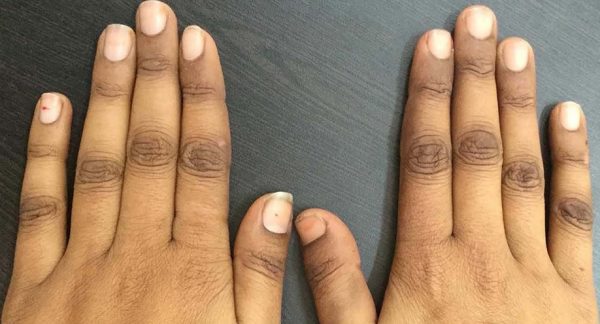 यो भिटामिनको कमीले हुन्छ छाला कालो