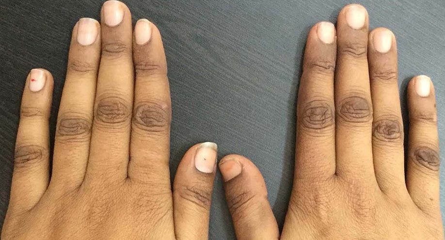 यो भिटामिनको कमीले हुन्छ छाला कालो