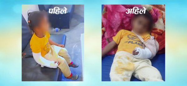 देब्रे हात भाँच्चिएर उपचार गर्न जाँदा दाहिने हातमा प्लास्टर, सञ्जालमा भाइरल (भिडिओ)