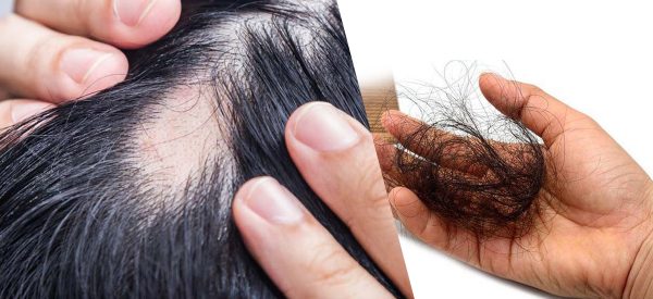 कम उमेरमै तालु खुइलियो ? हुन सक्छ ‘एलोपेसिया’