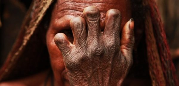 जहाँ परिवारका सदस्यको मृत्यु हुँदा महिलाका औँला काटिन्छ !